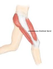 The iliotibial band is a lateral thickening of the fascia lata which can be weight bearing when standing up