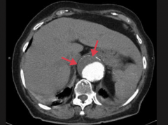 Abdominal aortic aneurysm
- Suprarenal
- Eccentric mural thrombus