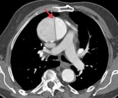 Thoracic aortic aneurysm
- Ascending aorta
- Dissection (arrow)