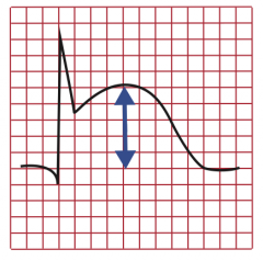 ECG (in first 6 hours)
- ST elevations (ST elevated MI = STEMI, acute transmural infarct)
- ST depression (subendocardial infarct)
- Pathologic Q waves (evolving or old transmural infarct)