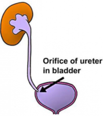 Likely to lodge in the orifice of the ureter and bladder (hollow tube tends to narrow here)