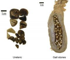 Where are calculi (i.e. ureteric and gall stones) likely to lodge? 