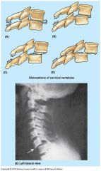 Cervical Vertebra are less interlocked and therefore can be dislocated the easiest (more prone to dislocation)

This can cause trauma to spinal cord and can present with spondoloythesis, with or without spondolysis