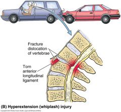 Acceleration/deceleration syndrome can cause this: forward and backward head snapping (rear ended collisions), Whiplashes can cause this

Damage to soft tissue, ligaments running along the vertebra.

This will causes inflammation

In severe ...