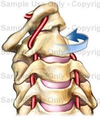 It is the sudden or forceful twisting of hyperextension or twisting of cervical vertebral column (mostly at Atlantoaxial joint)

This will impinge the arteries there and cause dizziness, vertigo, confusion, and nystagmus (uncontrolled jittery mo...