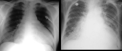 Left: cardiomegaly
Right: pulmonary edema