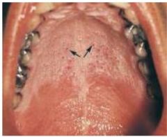 Name this mucosa disorder and how it happens