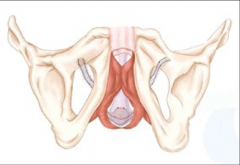 -Kegels. 
-Male sling (shown).
-Artificial urinary sphincter if it's really bad.