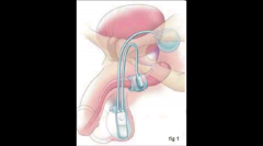 Artificial urinary sphincter.