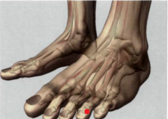 44VB

0,1 Tsun proximal y lateral al ángulo ungueal externo

del cuarto dedo del pie