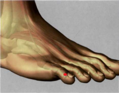 67V

0,1 Tsun por detrás del ángulo ungueal externo

del dedo pequeño del pie