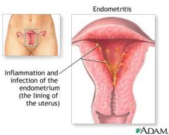 Infection of the uterus

Presents with:
- fevers, chills
- abdo pain, uterine tenderness, 
- foul-smelling discharge or lochia

RFs:
- C/S
- intrapartum chorioamnionitis
- prolonged labour
- prolonged ROM
- multiple vaginal examination...