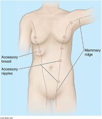 Polymastia-supernumerary breasts
Polythelia-supernumerary nipples
Growth of breast/supernumerary breasts, or supernumerary nipples will occur on the mammary ridge