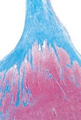 They prevent valves from collapsing The chordae insert on the fibrous cap (In blue) 
