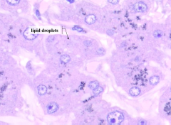 - Fewer granules are present in these cells
- Pink-staining lipid droplets make the hepatocyte cytoplasm appear foamy