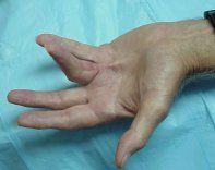Which of the following patients with Dupuytren's contracture would benefit the most from dermatofasciectomy and full-thickness skin grafting opposed to traditional fasciectomy? 
1.  70-year-old sedentary male with small finger involvement isolate...