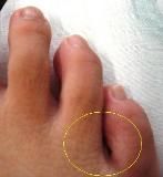 little toe