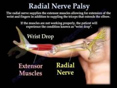 Causes: midshaft fractures of humerus, improper use of crutches

Extensor (posterior) compartments are affected

Clinical Presentation: Wrist drop, paresthesia and or pain along course of nerve

Saturday night palsy: nerve gets pinched due t...