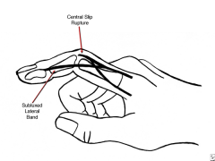 Boutonniere deformity is characterized with the PIP in flexion and the DIP in hyperextension as shown in Illustration A. It is caused by central slip rupture or attenuation (secondary to capsular distention, e.g., rheumatoid arthritis), laceration...