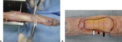 Hx:54yo F presents w/ a hand deformity. A surgical procedure is being considered that relocates the lateral bands dorsally to counteract the pathophysiology of the deformity. Which of the following deformities does this patient most likely have? 
...