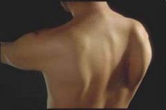 Causes: nerve damage during surgical removal of lymph nodes/tissues in axillary region, penetration trauma to axillary region

Affects: serratus anterior

Clinical Presentation: winged scapula and will not be able to raise the arm past 90 degrees