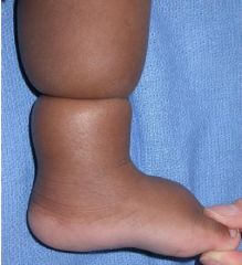 Figure A depicts a child with a congenital abnormality. Which of the following is true regarding this condition?  
1.  Circumferential trunk involvement is more common than distal extremities involvement 
2.  Risk factors include late gestation ...