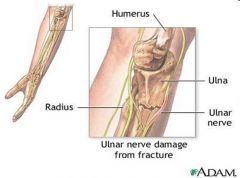 Causes: fracture of medial epicondyle of humerus, fracture of proximal ulna, slashed medial wrist
Affects posterior compartment
Affects: flexors of wrist, digits, and intrinsic hand muscles

Clinical Presentation: radial deviation at wrist joi...