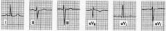 -left axis deviation


(NO QRS widening, hypertrophy, or strain)