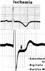symmetrically inverted T waves (top)


or


ST segment depression w/ normal T wave (bottom)