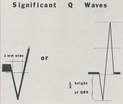 Q waves


^ either 1 box wide


OR


1/3 total height of R