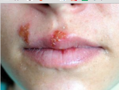 Red vesicles that have ruptures around the mouth resulting in shallow, painful, red ulcers