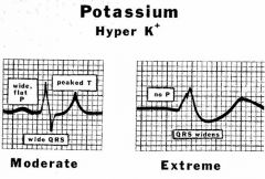 *wide QRS + no P is very DANGEROUS = extreme hyperkalemia--> infarct