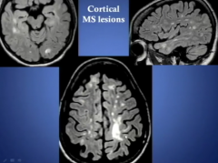 Cortical Lesions More Common Than Previously Known!