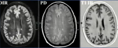 DIR Double Inversion Recovery
PD
T1 Inversion Recovery
BEST to See Cortical Lesions!