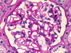 Glomerulus. Square indicates a capillary wall. Note that RBCs have to get from the capillary to the Bowman's space iot get into the urine.