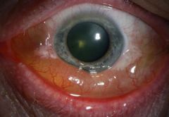 conjunctiva of eyelid + eyeball should be tight, but chemosis is when conjunctiva is swollen		-Looks like eye is popping out/ elevated (above sclera)