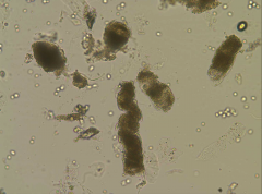 *Muddy brown casts in ATN. Membranes of these cells have been disrupted.
*Seen in acute tubular necrosis, LATE stage of injury; cells have been seriously degraded.