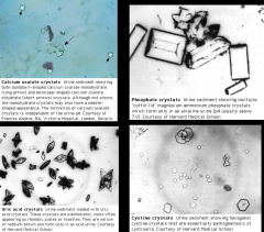 *Crystals!
1) Nephrolithiasis.
2) Ethylene glycol toxicity.
3) Precipitation in old (cooled) urine.