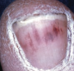 Nail-bed splinter hemorrhages - sign of bacterial endocarditis