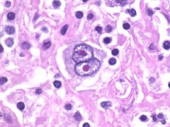 1. lymph node biopsy- The presence of Reed Sternberg cells is required to make the diagnosis. 
   - neoplastic, large cell with two or more nuclei, look like owl's eye.
 - usually b-cell phenotype
 - Reed Sternberg cells may be found in other n...