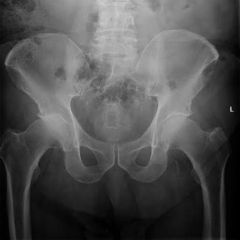 Adult c/o pain in the posterior gluteal region and migrating down the back of the leg burning pain, aching in nature PE=hip exam Flexion, Adduction, and Internal Rotation of hip reproduce sx.
1-KIF -->Dx 
2-indications Tx 
2.1first line of trea...