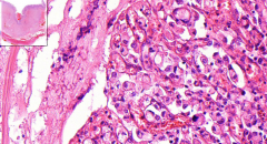 Stomach
- THICK stomach submucosa (usually very thin)
- A lot of fibrous tissue produced, no architecture
- Among fibrous tissue we see 'signet ring cells'
=> Called 'desmophilic reaction'
- High mitosis, nucleoli

Etiology?
Other names?
...