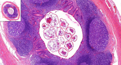 Appendix
- Parasites in lumen
- No inflammation
- Eosinophils in wall

Etiology?