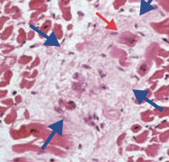 - Aschoff bodies (granuloma with giant cells - blue arrow)
- Anitschkow cells (enlarged macrophages with ovoid, wavy, rod-like nucleus - red arrow)