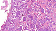 Ileum
- Islands of trabecules of uniform cells
- Normal nuclei with chromatin, low mitosis

Etiology?
Immunohistochemistry?
Complications?
Classification of neuroendocrine tumors?