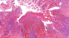 Ileum
- Giant cell granulomas with no central necrosis
- Ulcers & hyperemia of mucosa
- Transmural mixed inflammatory infiltrate (ly, plasm)
- Areas of scarring
- Dysplastic changes = precancerous!

Etiology?
Complications?