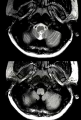 PosteroLateral Medulla MS
Better Seen on T2 Than Flair