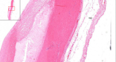 - Hyaline fibrotic tissue (fibroblasts, smooth muscle, foamy cells)
- Covered with fibrous layer (fibrous cap)
- Centrally: Amorpheus necrotic tissue

Etiology?
Macro?
Risk factors?
Complications?