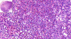 Lymph node
- Destroyed normal structure
- Fibrotic binds
- Peripheral eosinophilia
- Reactive, infiltrative background
- Pathognomonic cells - 2 types?

Etiology?