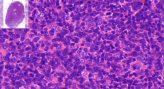 Lymph node
- Follicular pattern
- Small - angulated cells are?
- Large, vesicular nuclei cells are?
- Germinal centers in medulla - cells are activated

Etiology?
